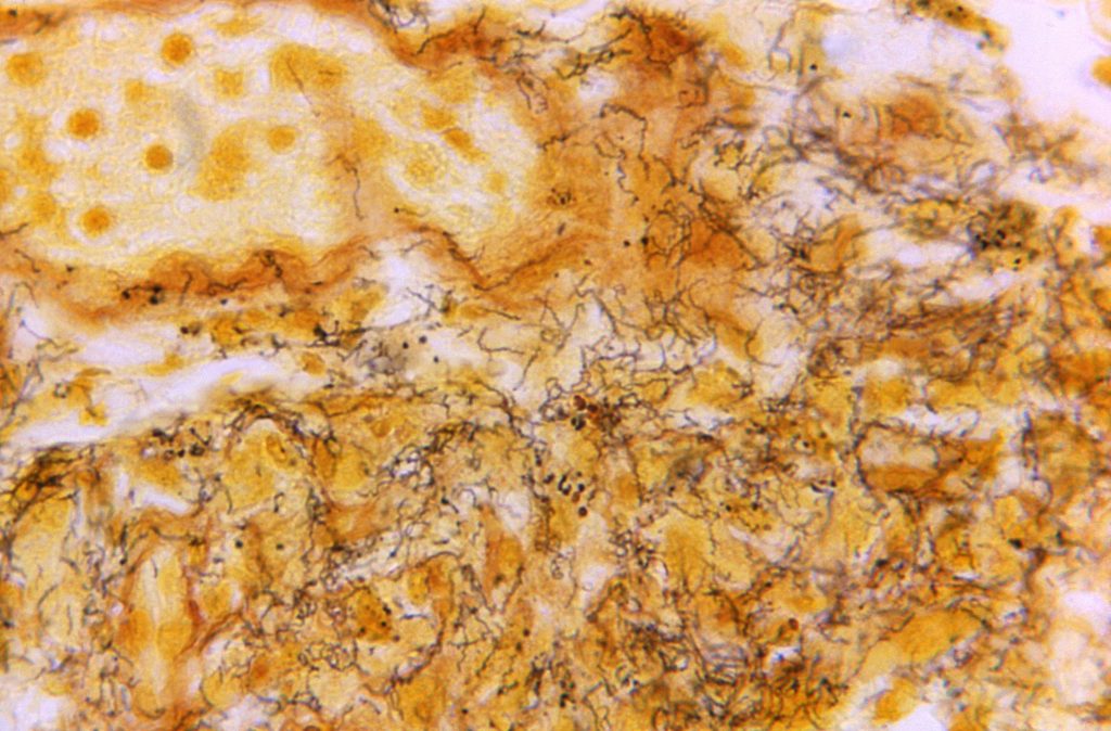 FILE - This 1966 photomicrograph released by the Centers for Disease Control and Prevention shows a heavily stained corkscrew-shaped tissue sample full of Treponema pallidum spirochetes, the bacterium that causes syphilis. is shown.  (Skip Van Orden/CDC via AP, File)