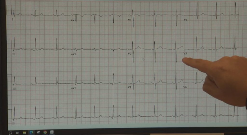 A NORMAL ECG heart rate scale